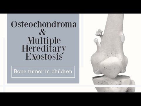 Osteochondroma & Multiple Hereditary Exostosis - bone tumor in children (subtitled)