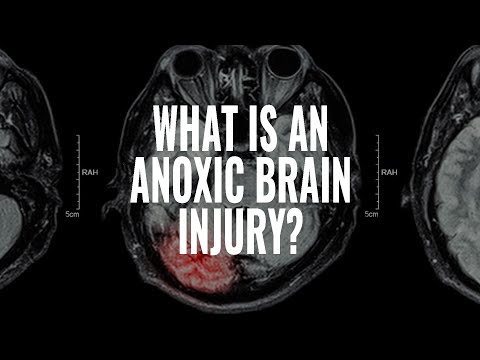 What is an Anoxic Traumatic Brain Injury? I The McCraw Law Group