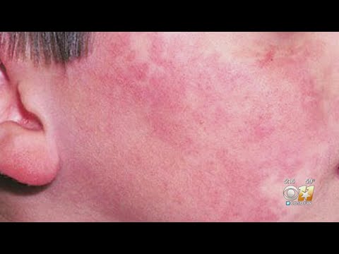 A 'Rash' Of Fifth Disease Making The Rounds In North Texas