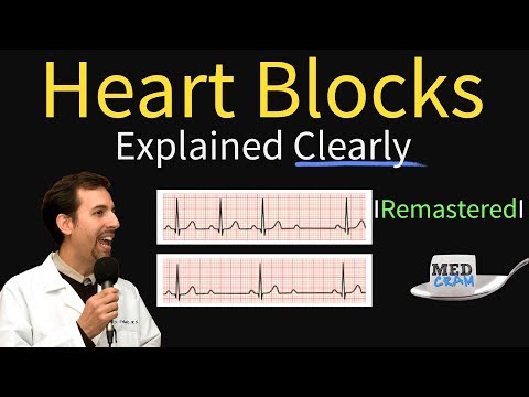 Heart Blocks Explained - First, Second, Third Degree and Bundle Branch on ECG