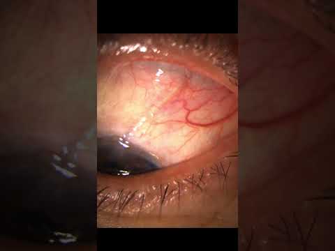 Glaucoma Surgery:  Ahmed Valve