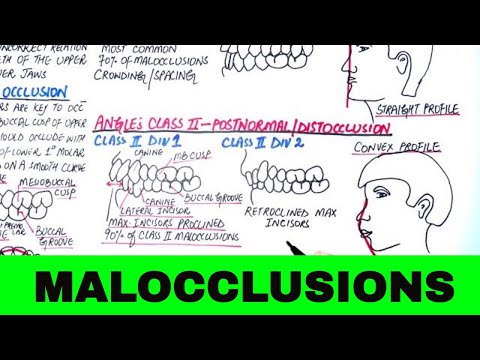 Angle's Classification of Malocclusion - Orthodontics