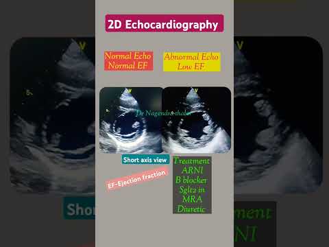 Normal and abnormal Echo l Ejection fraction l Heart pumping Power #echo #shorts