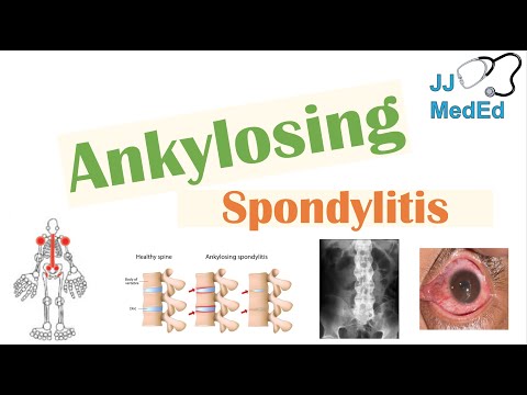 Ankylosing Spondylitis | HLA-B27, Pathophysiology, Signs & Symptoms, Diagnosis, Treatment