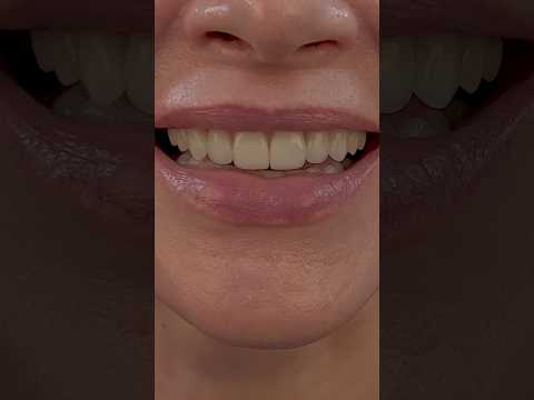 10 Porcelain Veneers #veneers #smilemakeover #dentist