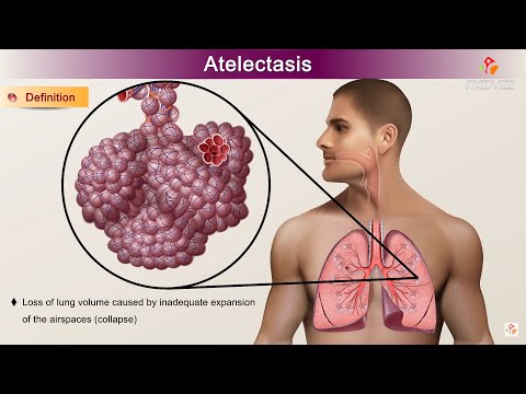 Atelectasis : Etiology, Clinical Features, Pathology, pathophysiology, Diagnosis, and Treatment