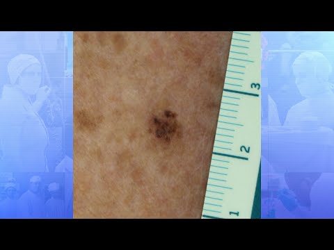 Ask an Expert: How to Spot Skin Cancer