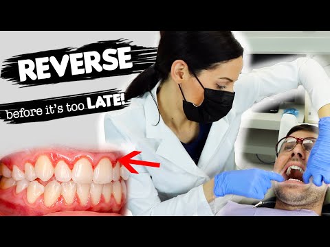 How To Treat Gum Disease