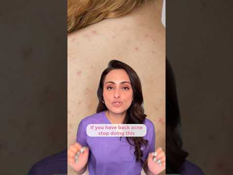 Back acne | how to treat | what to avoid