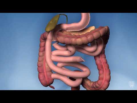 Biliopancreatic diversion with duodenal switch