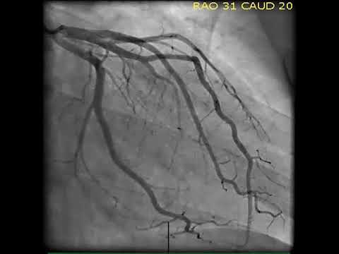 Coronary Angiography | NEJM