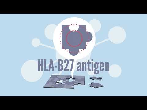 HLA B27 History with Ankylosing Spondylitis