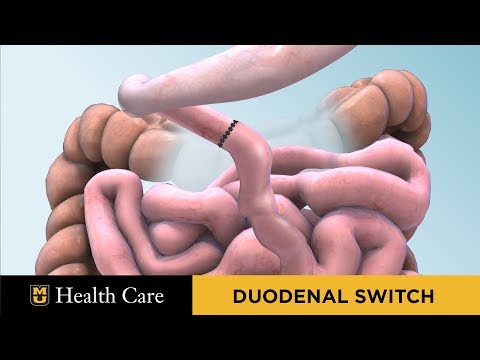 Bariatric Surgery Seminar: Duodenal Switch