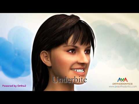 Malocclusion - Different Types