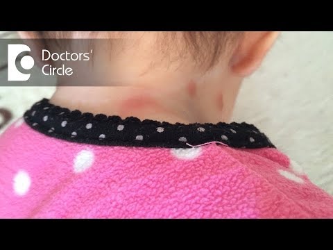 Does swelling & redness point toward spider bite? - Dr. Nischal K