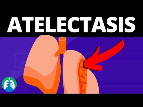 Atelectasis (Medical Definition) | Quick Explainer Video