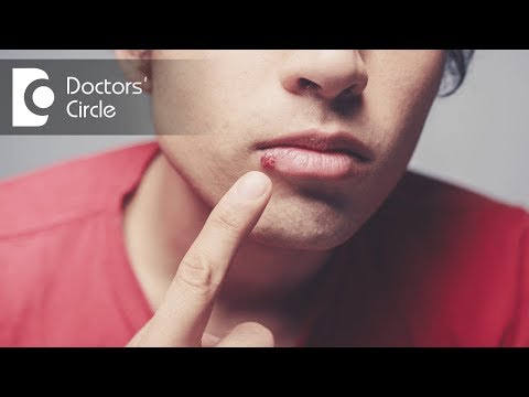 What is Herpes Labialis? - Dr. Aniruddha KB