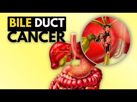 BIle Duct Cancer (Cholangiocarcinoma), Causes, Signs and Symptoms, Diagnosis and Treatment.