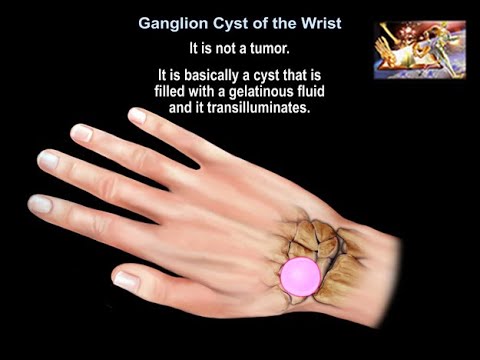 Ganglion Cyst Of The Wrist - Everything You Need To Know - Dr. Nabil Ebraheim