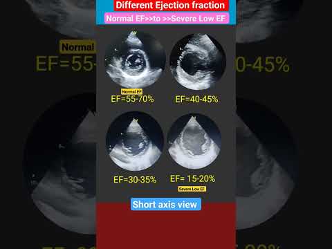 Normal to severe Low Ejection fraction Echo l EF 15-20% #echo #heartattack #shorts