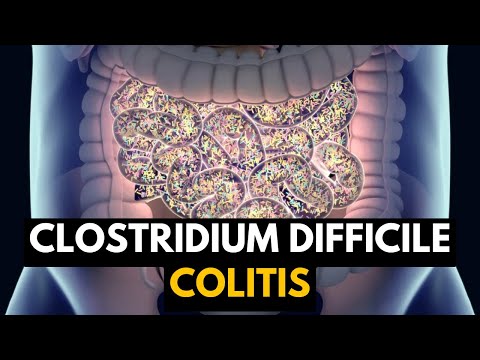 CLOSTRIDIUM DIFFICILE COLITIS, Causes, Signs and Symptoms, Diagnosis and Treatment.