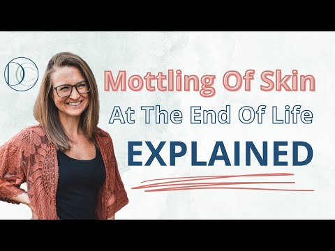 Mottling of Skin at the End Of Life