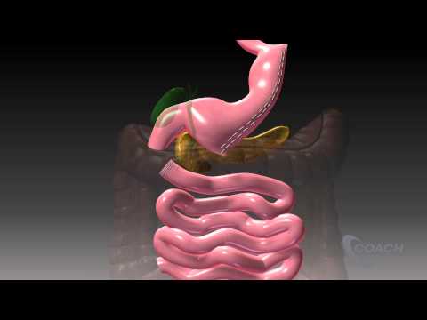 Duodenal Switch