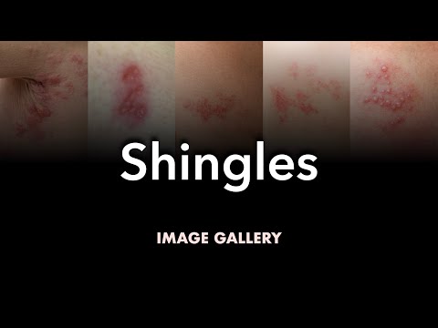 Shingles (Herpes Zoster): Image Gallery