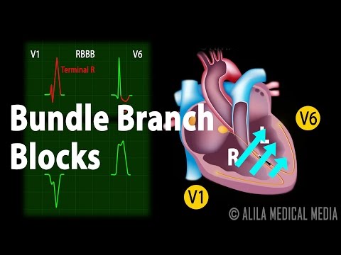 Bundle Branch Block, Animation.