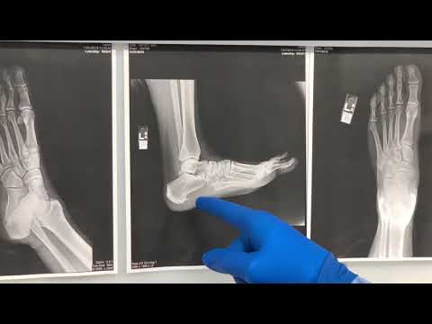 Explanation of Plantar Fascia Release by Correcting Calcanea Exostosis (Spur)