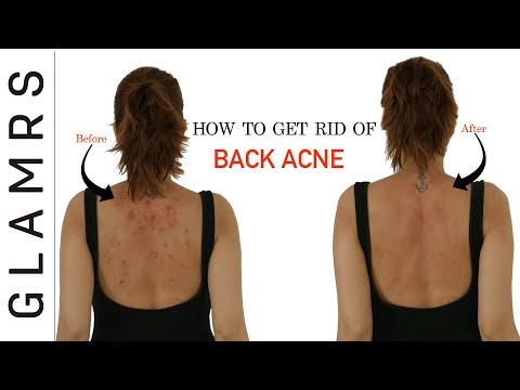 How To Get Rid of Back Acne the Natural Way | Effective Home Remedies