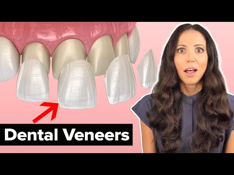 Dental Veneers Procedure Explained