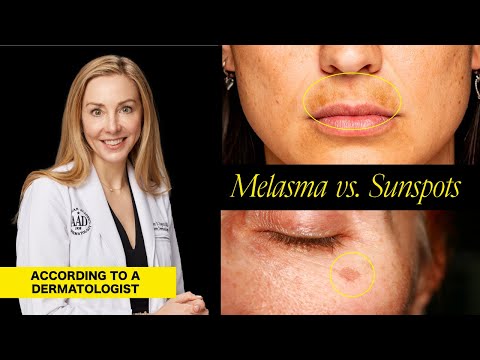 Understanding Melasma and Sunspots: Key Differences, Causes, and Treatment Options