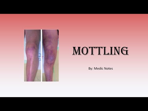 Skin mottling - definition, causes, pathophysiology, sign value