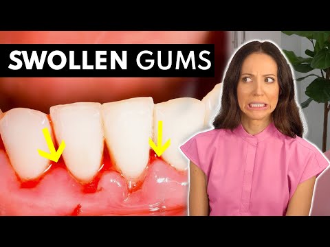 What SWOLLEN GUMS Are Telling You & What To Do About It!